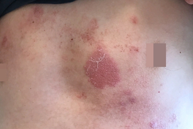 慢性湿疹胸部红斑图