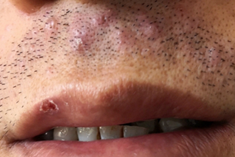 毛囊炎口周症状图 毛囊炎口周症状图