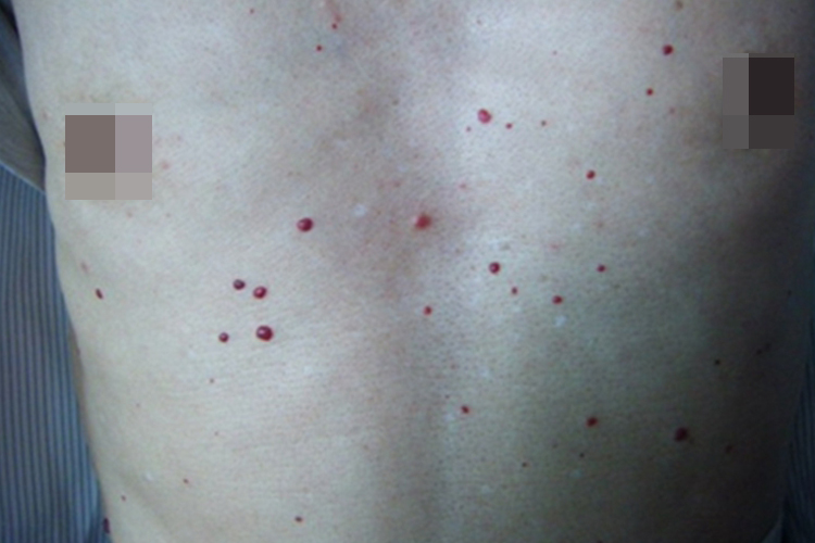 丘疹型血管角皮瘤胸部症状图