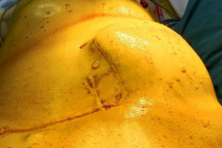 脂肪肉瘤左侧腹部肿块图 脂肪肉瘤左侧腹部肿块图