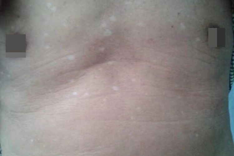 特发性点状色素减退斑胸部症状图