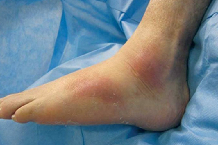 硬化性脂膜炎脚踝红斑图 硬化性脂膜炎脚踝红斑图