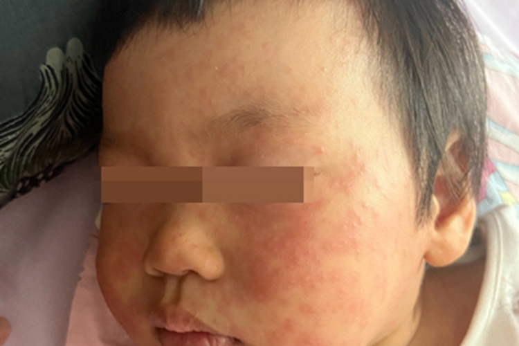 幼儿急疹面部症状图