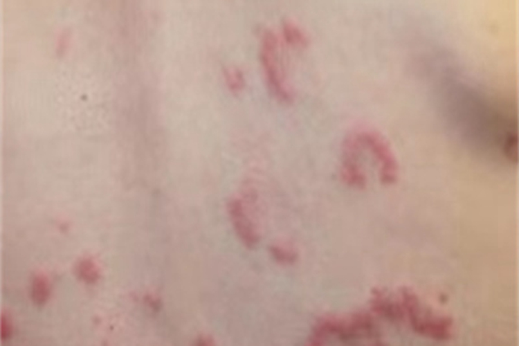 皮肤淋巴细胞浸润症背部红斑图 皮肤淋巴细胞浸润症背部红斑图