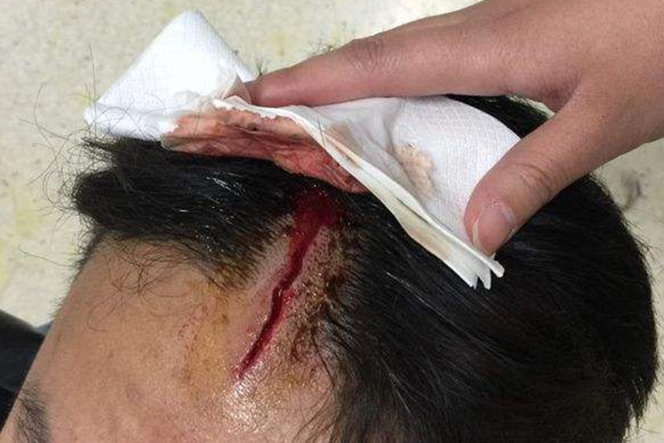 头皮裂伤图