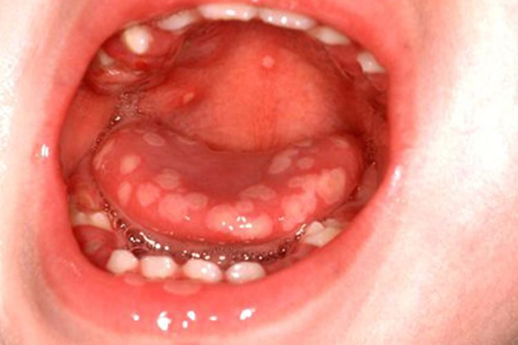 小孩手足口病舌部疱疹图