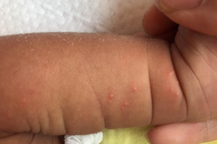 婴儿期特应性皮炎小腿长小疙瘩图