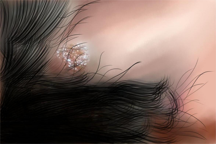 生殖器疱疹溃烂图 生殖器疱疹溃烂图