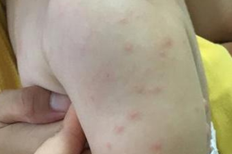 一过性散在皮疹图