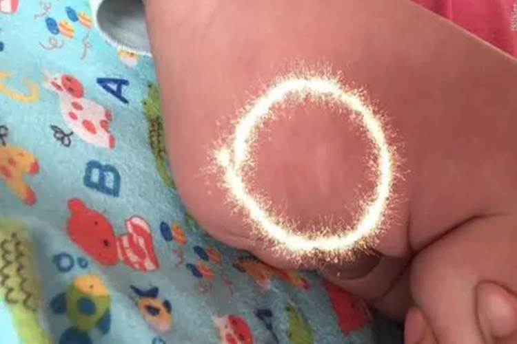 婴儿臀部白色胎记图 婴儿臀部白色胎记图