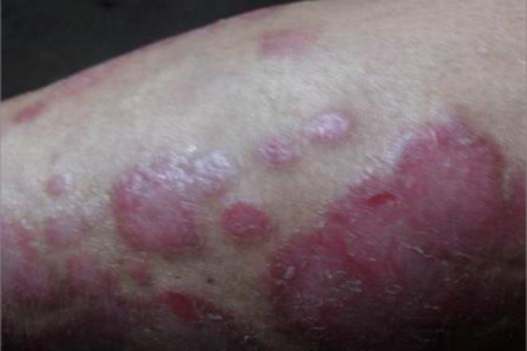 女性梅毒大腿症状图