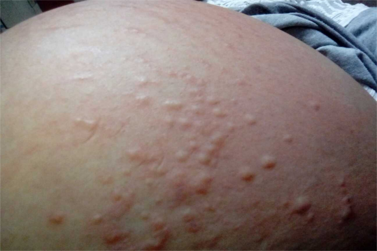 妊娠多形疹腹部疙瘩图
