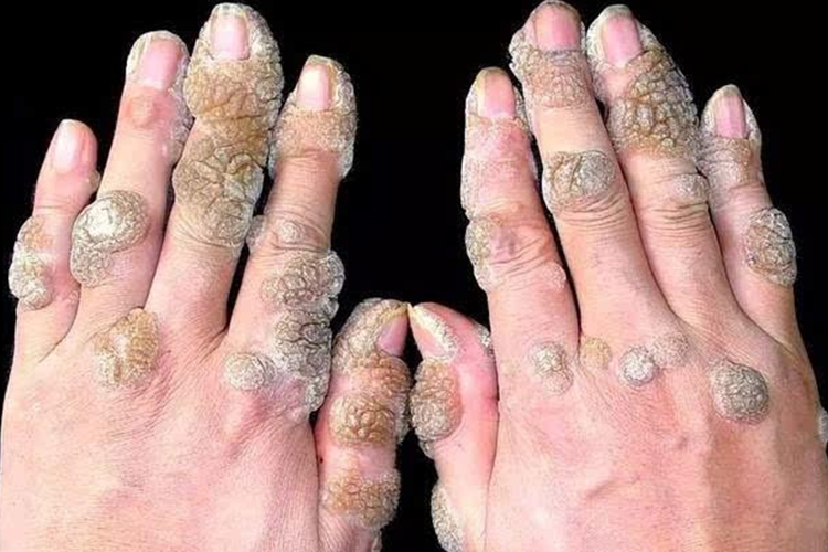 疣状表皮发育不良图