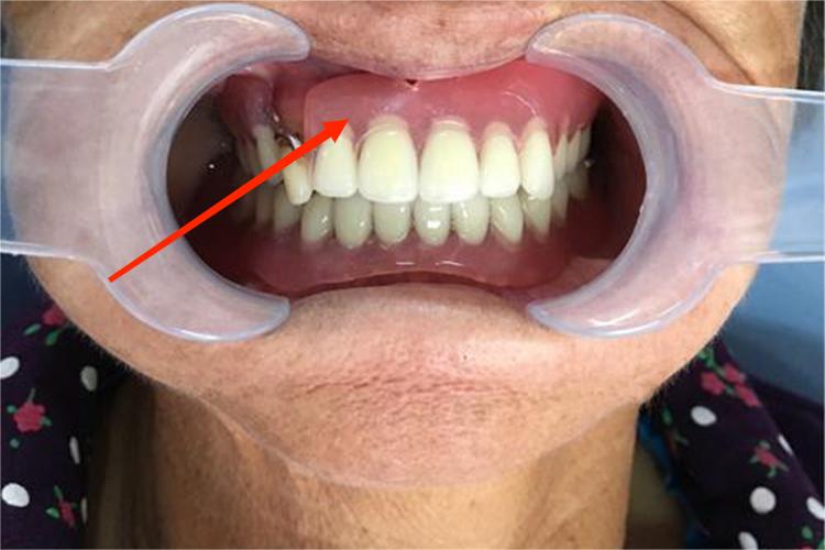 前牙隐形义齿图