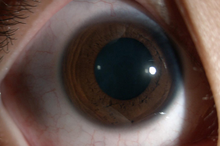 结膜发红充血图