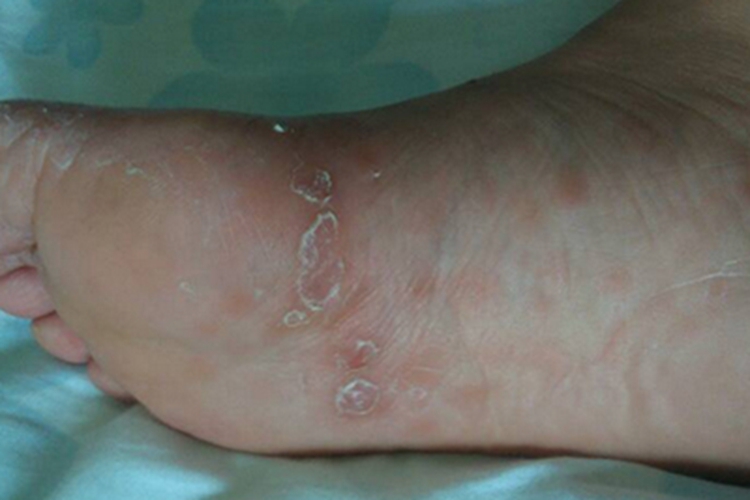 女性二期梅毒脚部症状图