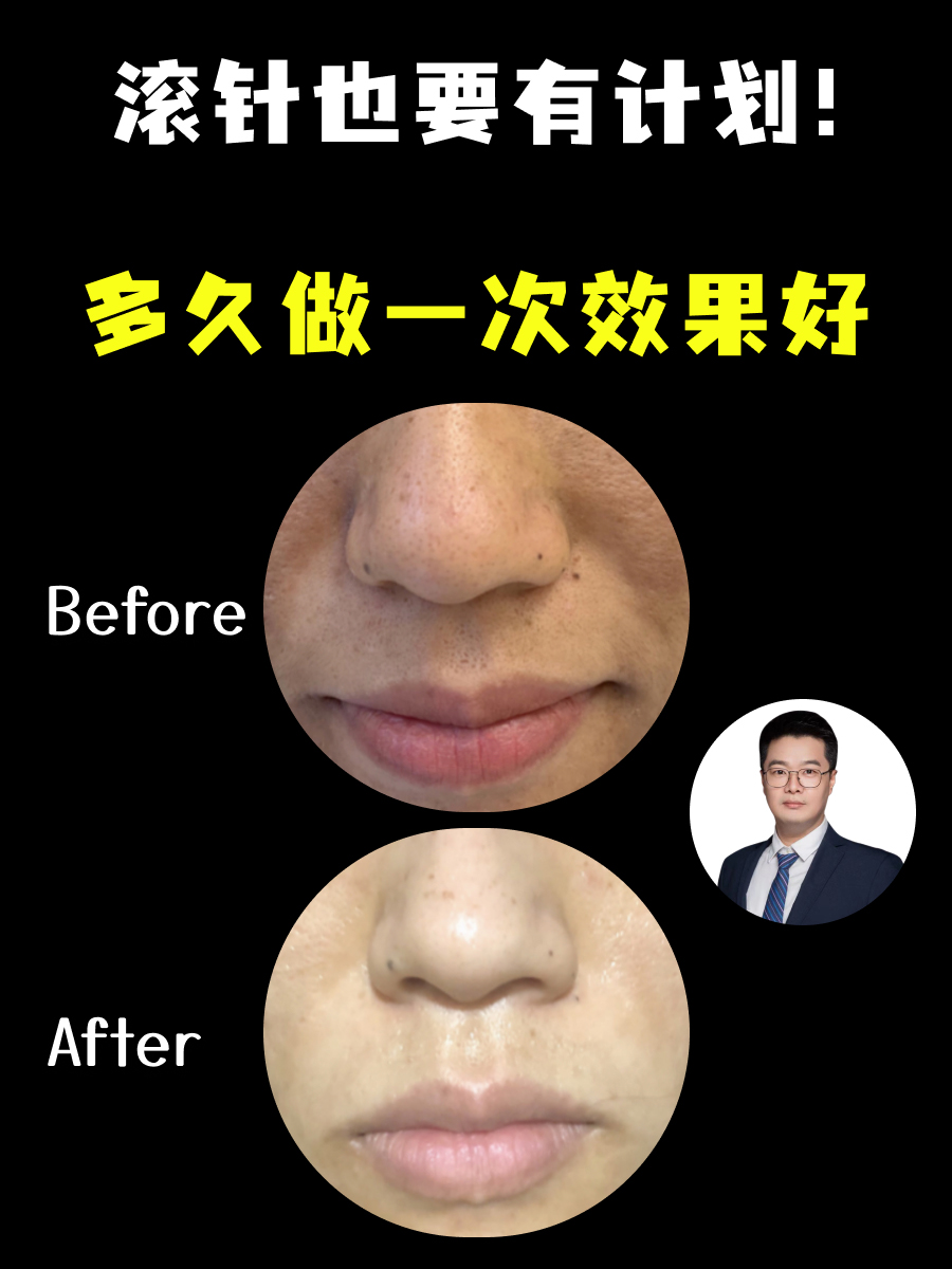 滚针也要有计划！多久做一次效果好？