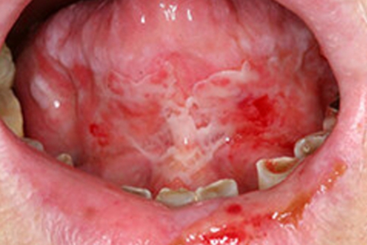 副肿瘤性天疱疮溃疡图