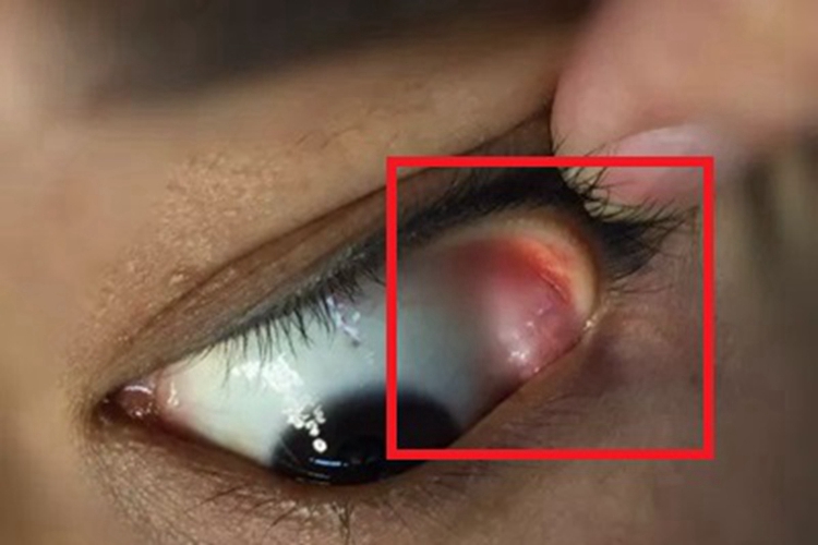 泪腺脱垂眼球症状图