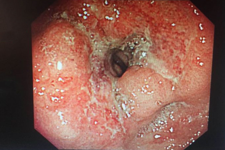 胃窦癌图 胃窦癌图