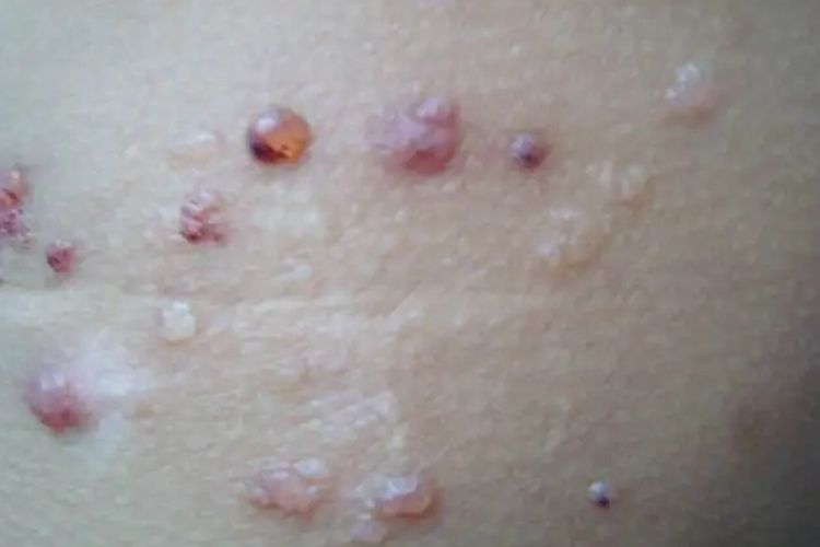 单纯性淋巴管瘤图