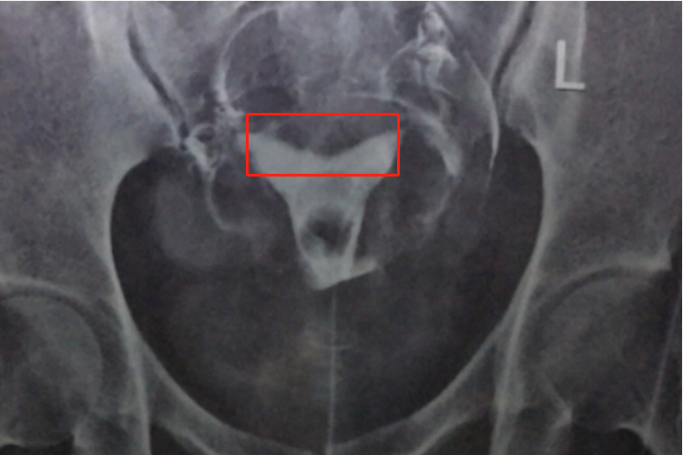 轻度鞍形子宫造影图