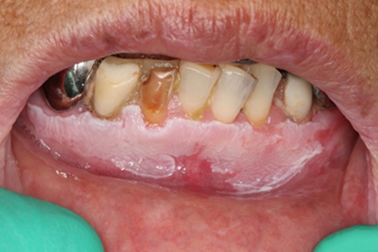 口腔白斑病牙龈皱纸状白斑图