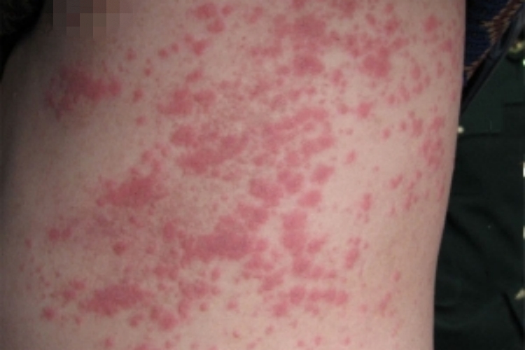 螨虫皮炎肋部散在红斑图