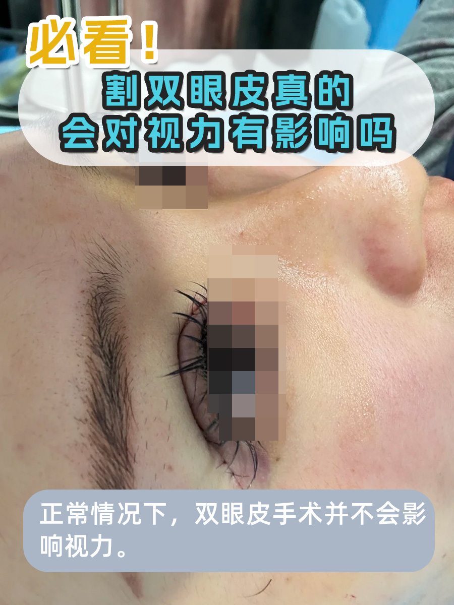 必看!割双眼皮真的会对视力有影响吗
