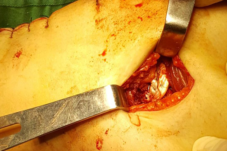 髌骨脱位手术股骨骨道操作图