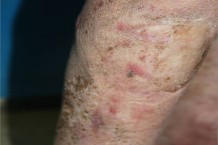 瘰疬性皮肤结核瘢痕图 瘰疬性皮肤结核瘢痕图