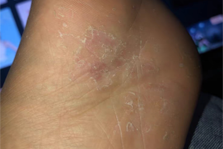 鳞屑角化型足癣脚底脱屑图