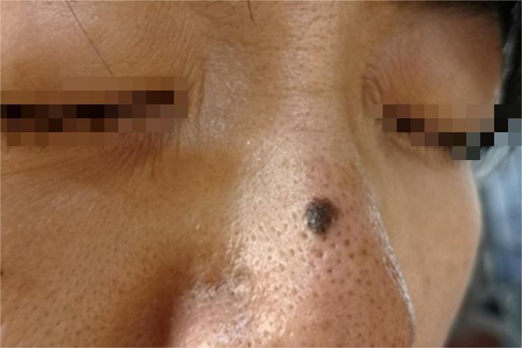 黑素细胞痣鼻部斑图