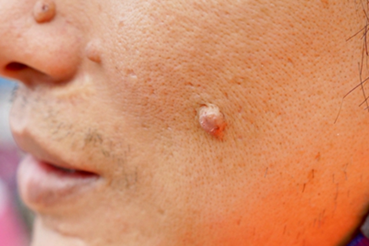 单发性有蒂软纤维瘤症状图