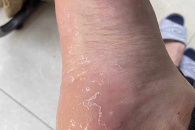 鳞屑角化型足癣增厚图