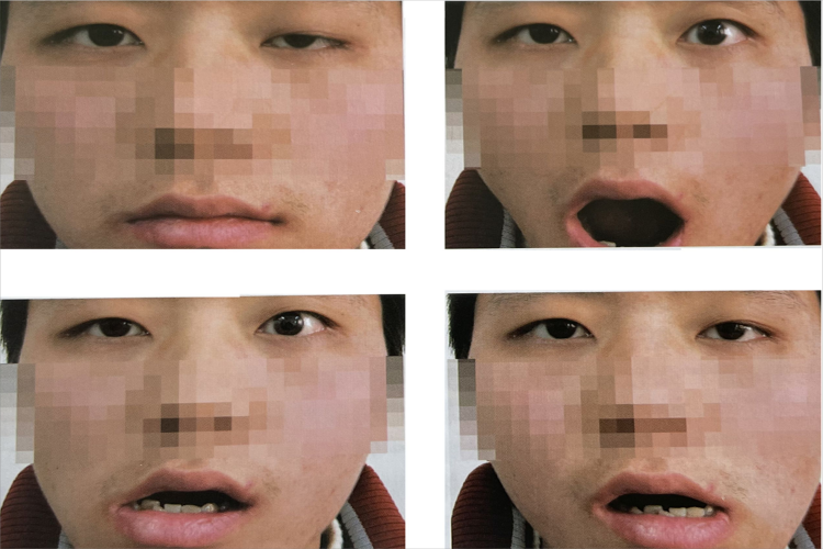 下颌瞬目综合征图