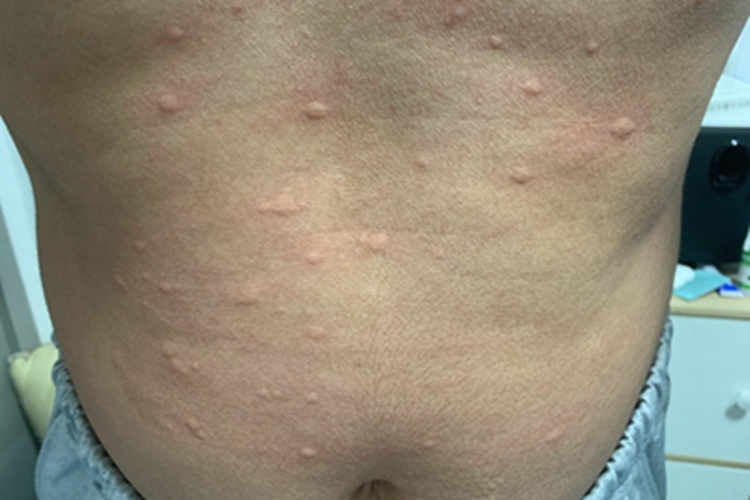 接触性荨麻疹肚子长疙瘩图
