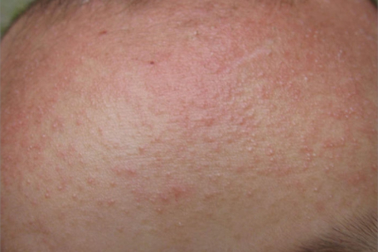 红痱前额丘疹图 红痱前额丘疹图