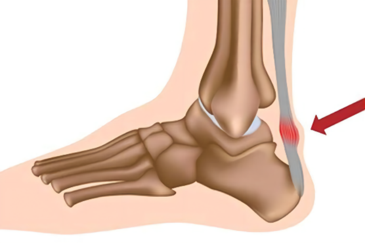 跟腱炎疼痛位置图