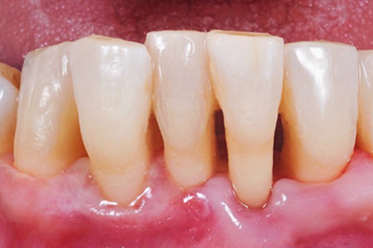 牙龈退缩下排牙龈萎缩红肿图