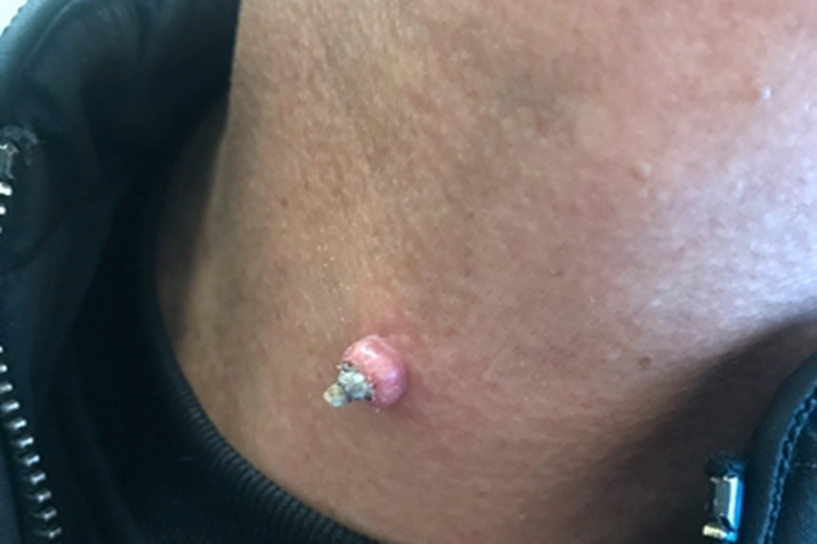 角化棘皮瘤颈部疙瘩图