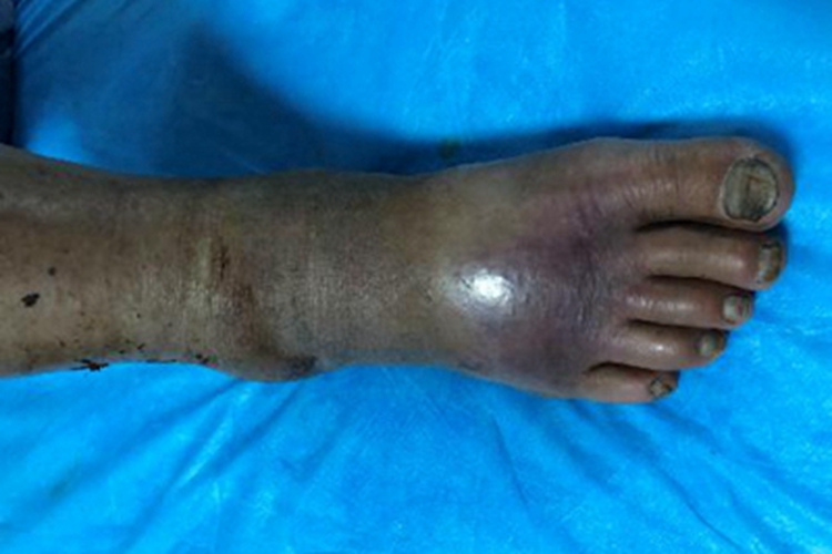 念珠状链杆菌型鼠咬热脚背症状图