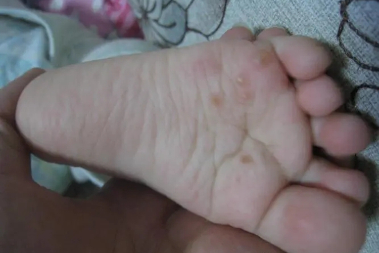 婴幼儿足癣水疱图