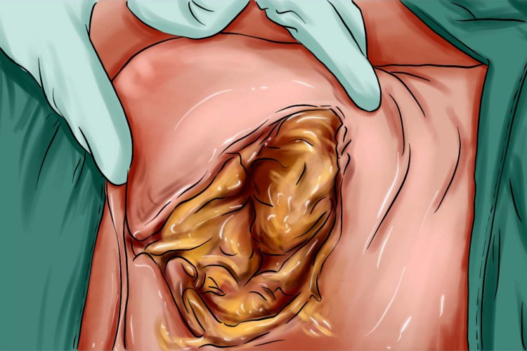 特发性阴囊坏疽图 特发性阴囊坏疽图