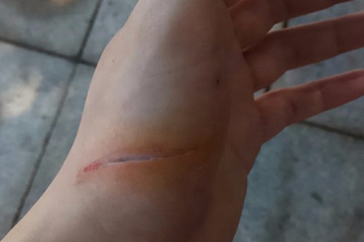 割伤手掌裂口不渗血图 割伤手掌裂口不渗血图