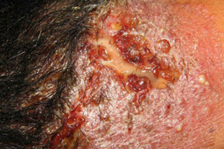 痈脖子侧面溃疡流脓图