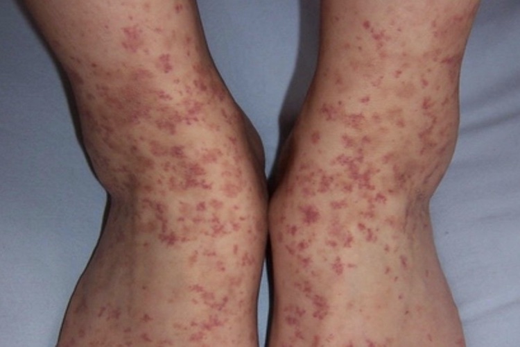 小孩特发性血小板减少性紫癜瘀点图 小孩特发性血小板减少性紫癜瘀点图