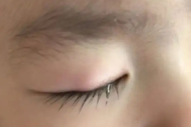 霰粒肿初期图 霰粒肿初期图