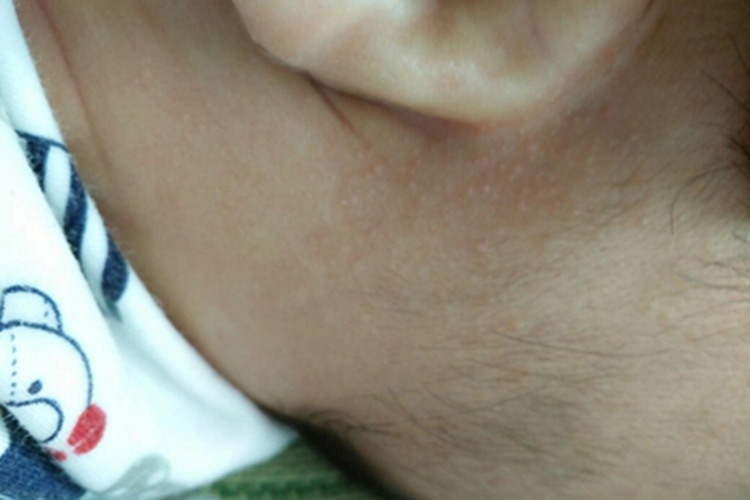新生儿皮脂腺增生耳后丘疹图 新生儿皮脂腺增生耳后丘疹图