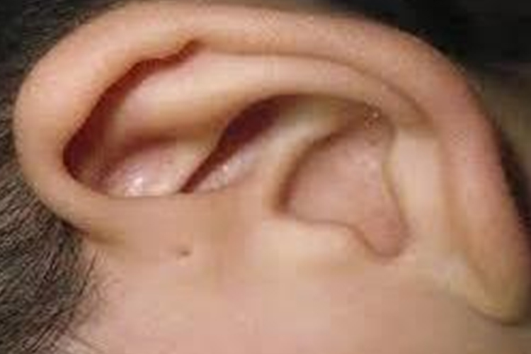 先天性耳前瘘管图